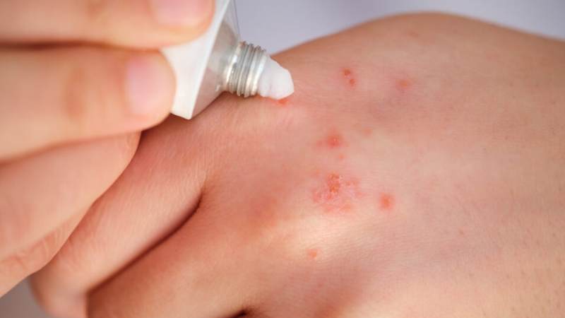 Chỉ nên sử dụng corticoid khi thực sự cần thiết và theo chỉ định của bác sĩ
