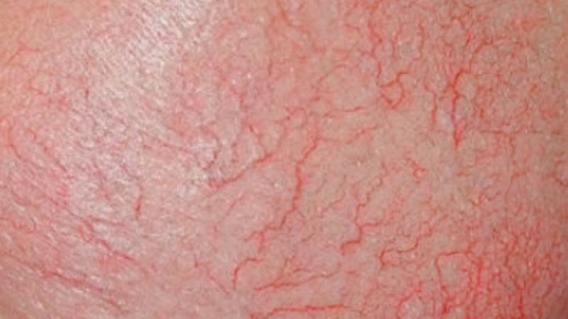 Viêm da giãn mạch là một trong những biến chứng khi da nhiễm corticoid
