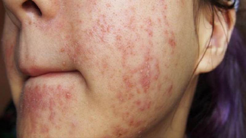 Tùy thuộc vào tình trạng tổn thương do corticoid, thời gian phục hồi sẽ khác nhau