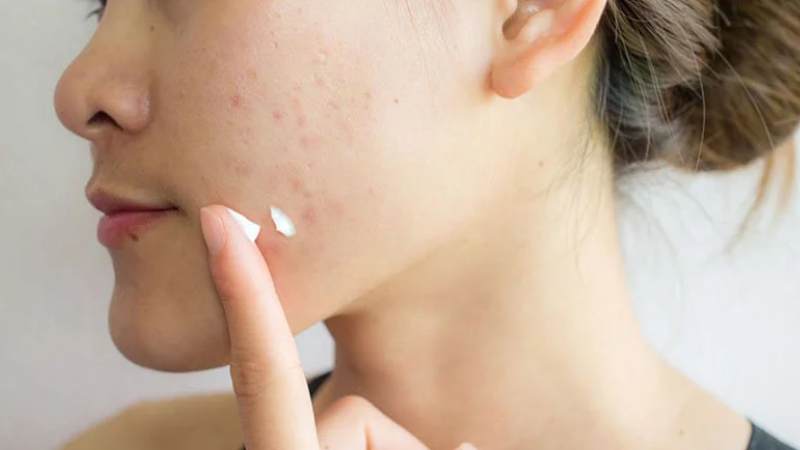 Bạn có thể sử dụng những thuốc kem mỡ kháng sinh đặc trị mụn theo hướng dẫn của bác sĩ