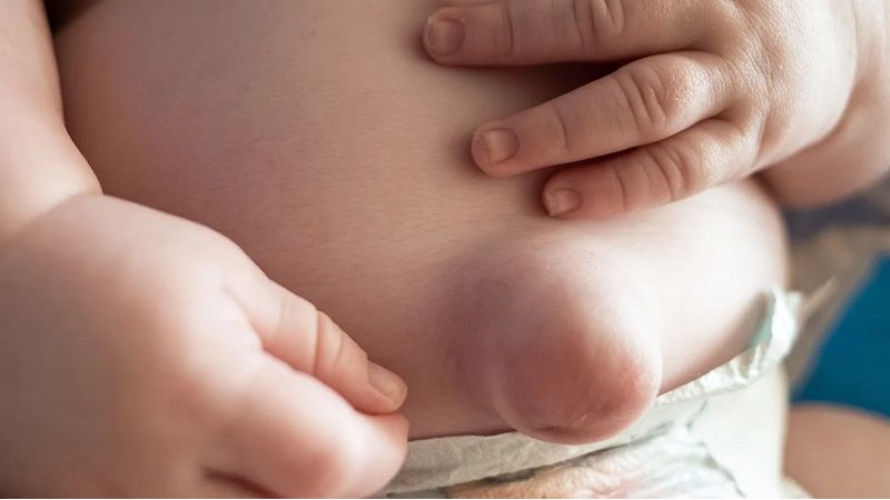 Thoát vị rốn có thể là nguyên nhân gây đau bụng quanh rốn ở trẻ em Thoát vị rốn có thể là nguyên nhân gây đau bụng quanh rốn ở trẻ em