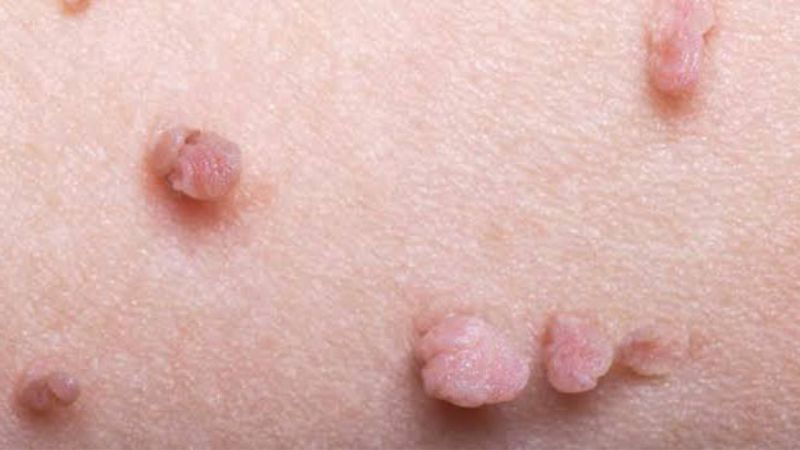 Nữ giới mắc bệnh thường có các nốt sùi mào gà ở quanh cơ quan sinh dục