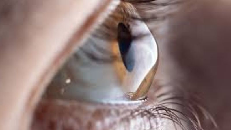 Giác mạc hình chóp là tình trạng biến đổi hình dạng của giác mạc làm suy giảm thị lực Giác mạc hình chóp là tình trạng biến đổi hình dạng của giác mạc làm suy giảm thị lực