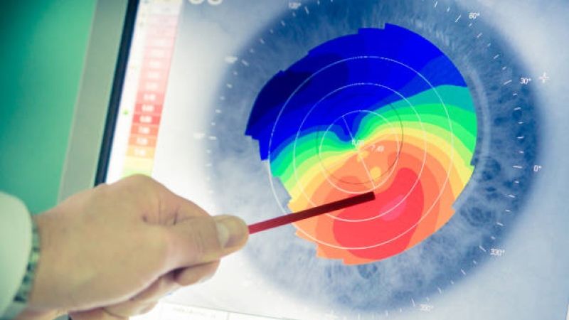 Chụp bản đồ giác mạc cho phép bác sĩ chẩn đoán bệnh giác mạc hình chóp Chụp bản đồ giác mạc cho phép bác sĩ chẩn đoán bệnh giác mạc hình chóp