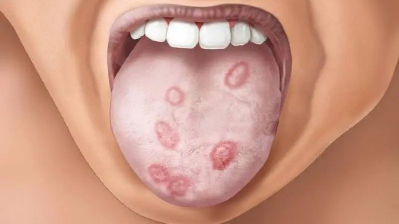 Ở giai đoạn đầu, bệnh nhân xuất hiện các vết loét tại miệng hoặc cơ quan sinh dục