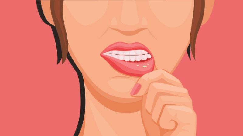 Sùi mào gà trong miệng có thể bị nhầm với nhiệt miệng