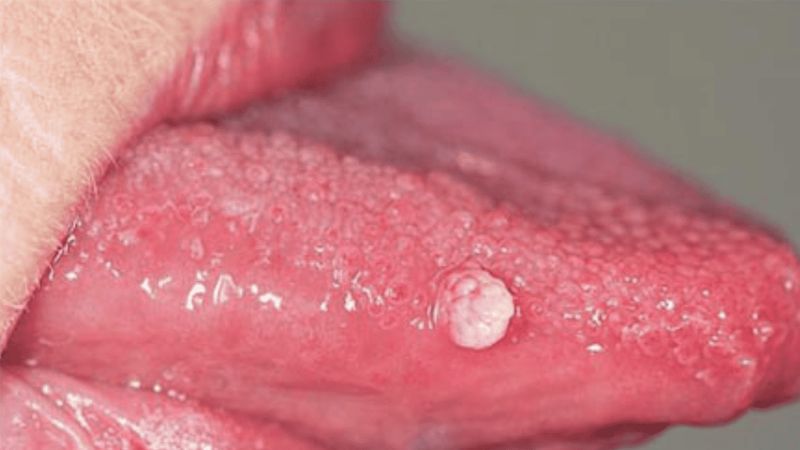 Một số trường hợp có thể gặp sùi mào gà tại lưỡi