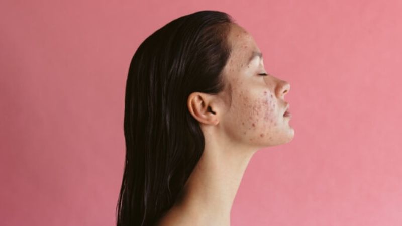 Mụn trứng cá không đáp ứng với các phương pháp điều trị khác có thể sử dụng isotretinoin