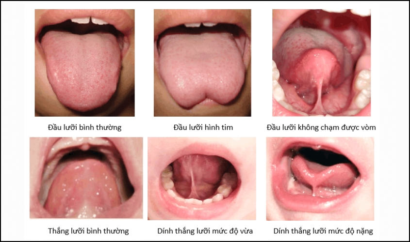 Hình ảnh lưỡi bình thường và dính thắng lưỡi Hình ảnh lưỡi bình thường và dính thắng lưỡi