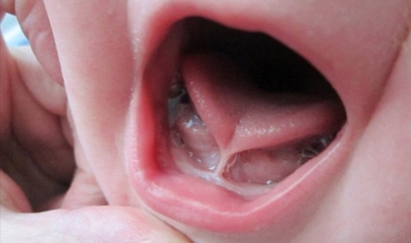 Dính thắng lưỡi xảy ra khi dải mô mỏng (gọi là thắng lưỡi) nối giữa mặt dưới của lưỡi và sàn miệng ngắn, dày hoặc dính bất thường Dính thắng lưỡi xảy ra khi dải mô mỏng (gọi là thắng lưỡi) nối giữa mặt dưới của lưỡi và sàn miệng ngắn, dày hoặc dính bất thường