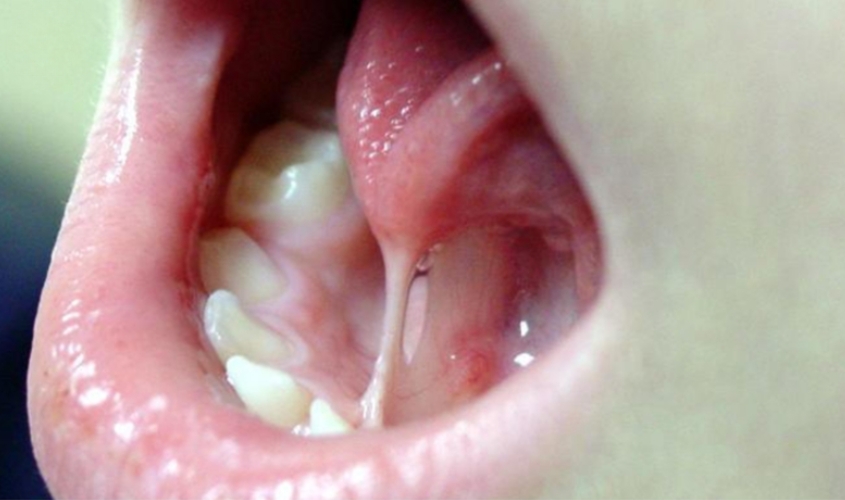 Dính thắng lưỡi có thể nhận biết qua việc quan sắt bằng mắt thường Dính thắng lưỡi có thể nhận biết qua việc quan sắt bằng mắt thường