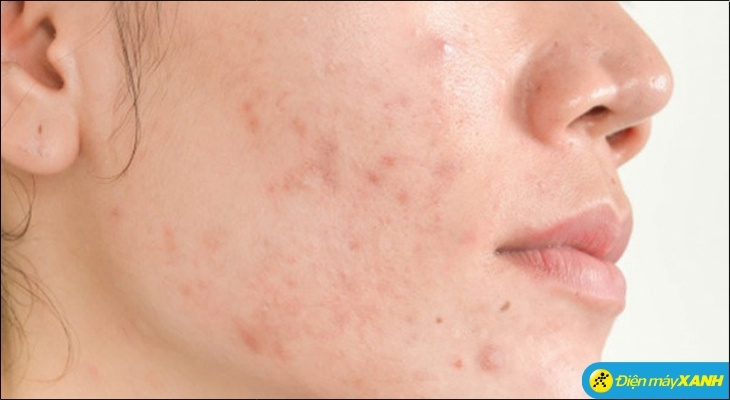 Đắp thêm dưỡng chất lúc da đang bị kích ứng chỉ khiến da quá tải, dẫn đế tình trạng nghiêm trọng hơn