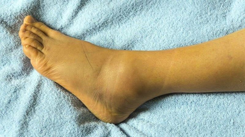 Vàng da sau dùng thuốc paracetamol là dấu hiệu cần gặp bác sĩ sớm