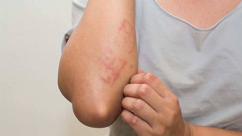 Viêm da cơ địa có thể gặp triệu chứng nổi mẩn đỏ kèm theo ngứa