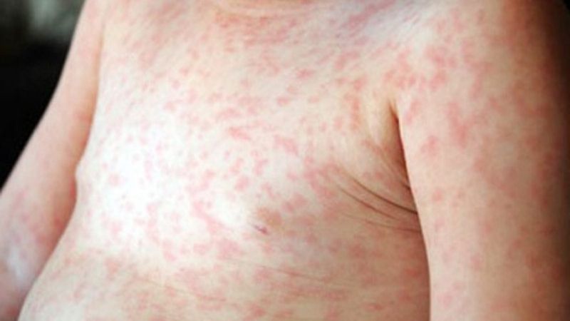 Sốt phát ban có thể gây nổi mẩn đỏ nhưng không kèm ngứa