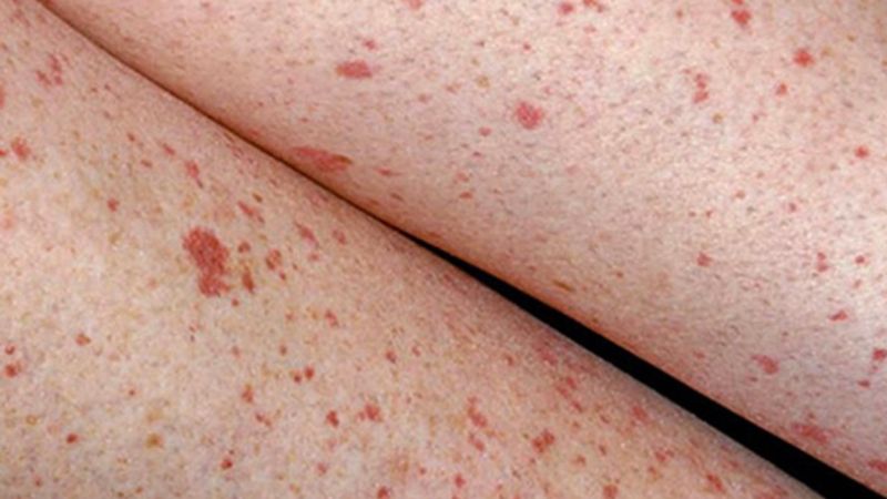 Nổi mẩn đỏ có thể do xuất huyết dưới da