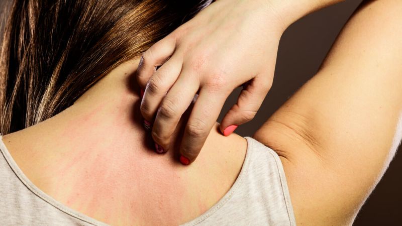 Nổi mẩn ngứa là tình trạng da có các nốt hồng nhạt kèm theo ngứa ngáy