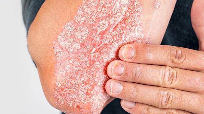 Nổi mẩn ngứa có thể là triệu chứng của bệnh vảy nến