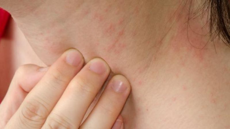 Nổi mẩn ngứa có thể kèm theo nổi cục dưới da