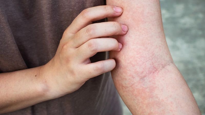 Một số bệnh nhân có thể bị nổi mẩn ngứa ở tay