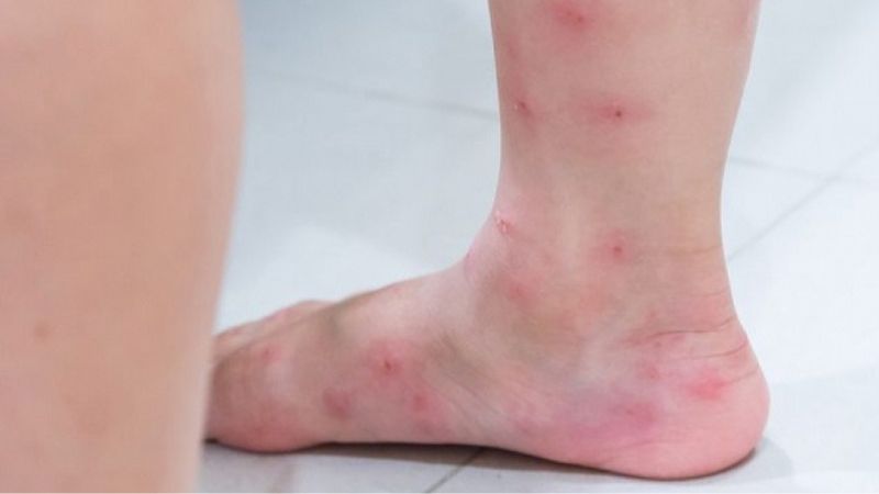 Nổi mẩn ngứa ở bắp chân khá phổ biến