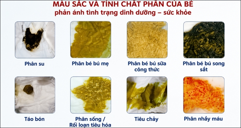 Các màu sắc phân thường gặp ở trẻ Các màu sắc phân thường gặp ở trẻ