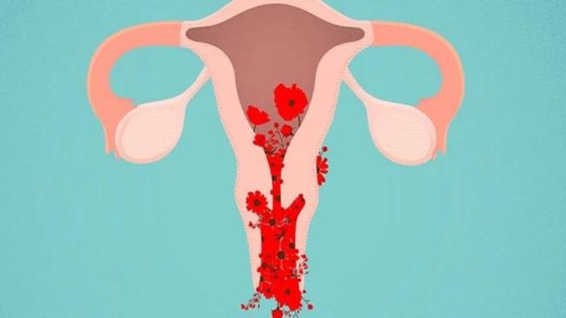 Polyp cổ tử cung có thể gây chảy máu âm đạo bất thường