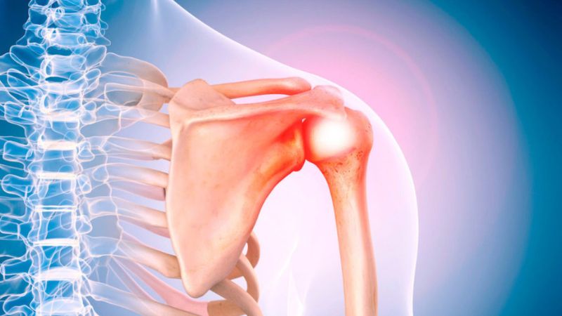 Rách cơ chóp xoay vai: Nguyên nhân, dấu hiệu và cách chữa trị