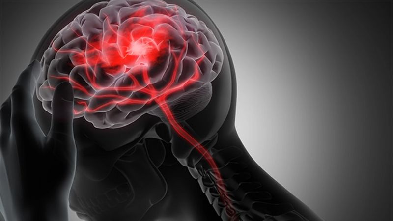 Sa sút trí tuệ mạch máu có thể xuất hiện sau nhiều cơn đột quỵ gây ổ nhồi máu nhỏ