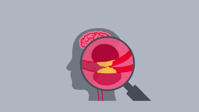 Các mảng xơ vữa mạch máu não có thể là nguyên nhân của bệnh