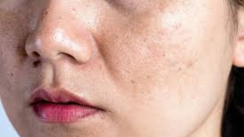 Sạm da là tình trạng da xuất hiện các mảng tăng sắc tố