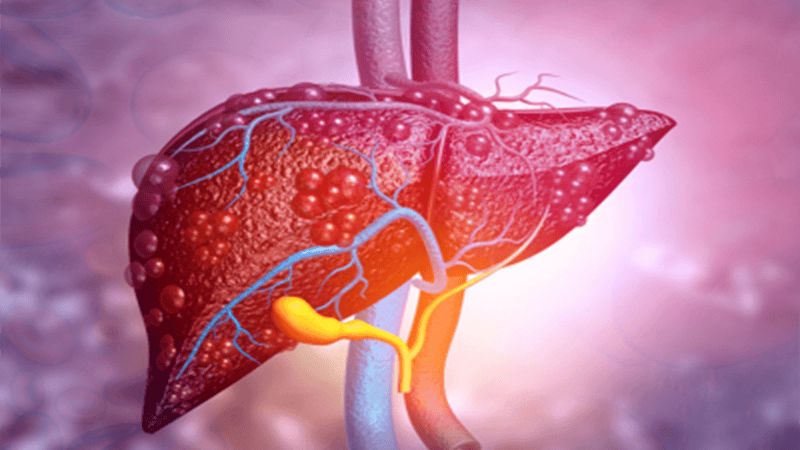 Sạm da là triệu chứng có thể gặp ở bệnh nhân xơ gan