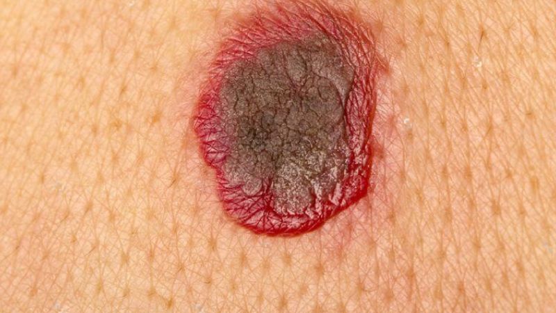 Sạm da kèm theo vết loét xung quanh là dấu hiệu cần đến gặp bác sĩ sớm