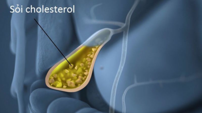 Sỏi cholesterol là một loại sỏi mật thường gặp Sỏi cholesterol là một loại sỏi mật thường gặp