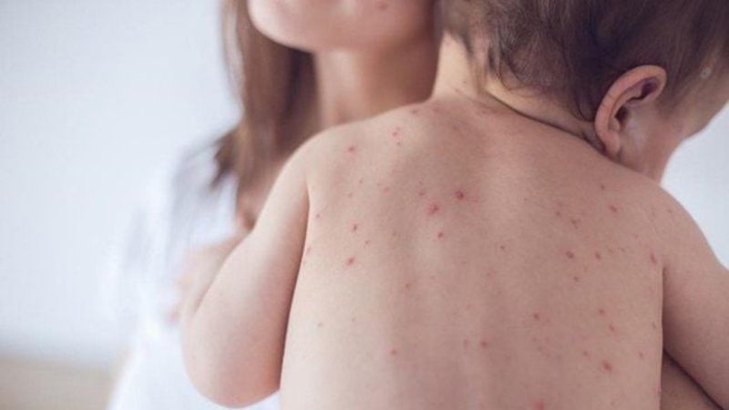Sốt phát ban ở trẻ thường có nốt phát ban đường kính nhỏ