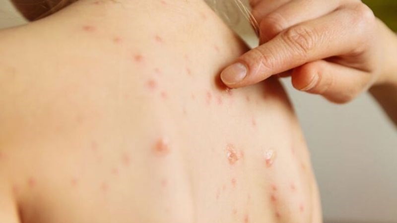 Phát ban do sởi thường gồ cao kèm theo ngứa ngáy
