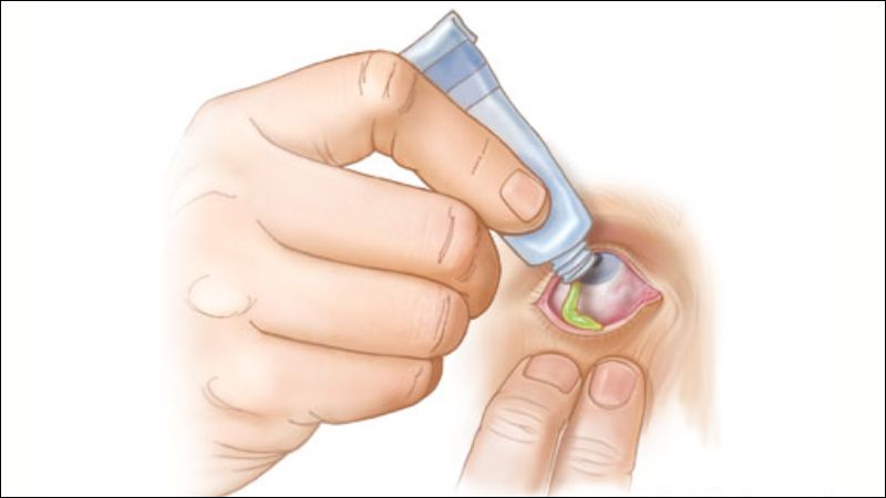 Thuốc mỡ tra mắt là một dạng thuốc bôi đặc biệt điều trị các bệnh về mắt