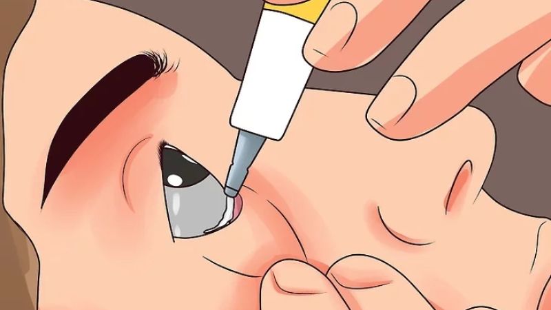 Thuốc mỡ tra mắt được chia thành hai nhóm chính là thuốc mỡ kháng sinh và thuốc mỡ bôi trơn