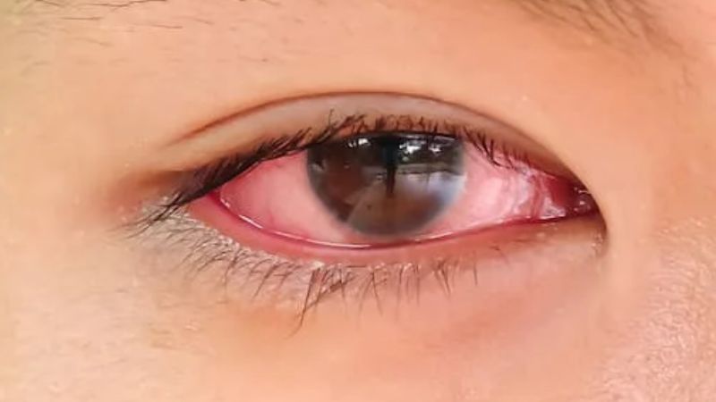 Thuốc mỡ tra mắt có tác dụng điều trị nhiễm trùng mắt và giảm viêm
