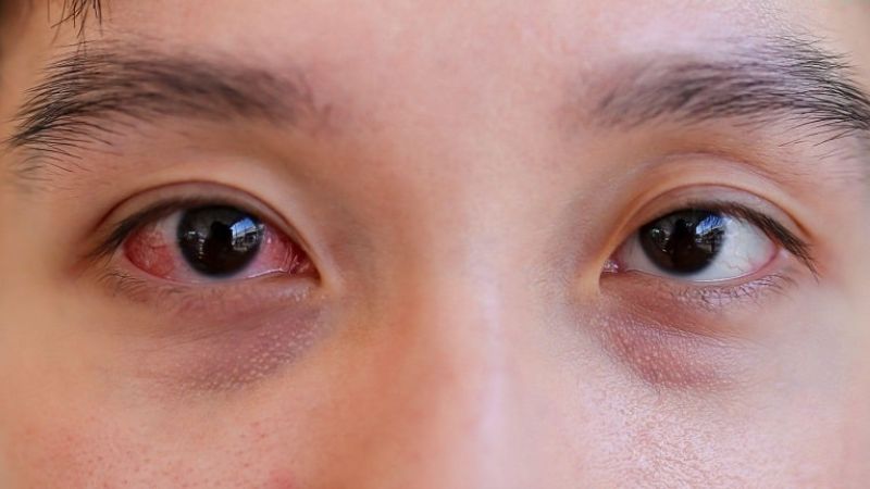 Thuốc mỡ tra mắt được sử dụng phổ biến trong điều trị nhiễm trùng mắt do vi khuẩn