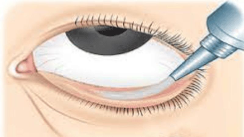 Thuốc mỡ tra mắt chứa kháng sinh giúp điều trị lẹo mắt 