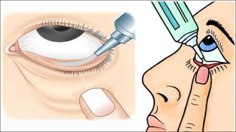 Bôi thuốc mỡ tra mắt vào bên trong mi dưới của mắt