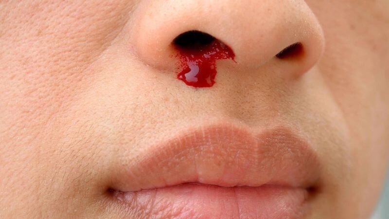 Chảy máu mũi thường xuyên có thể là triệu chứng sớm của bệnh Chảy máu mũi thường xuyên có thể là triệu chứng sớm của bệnh