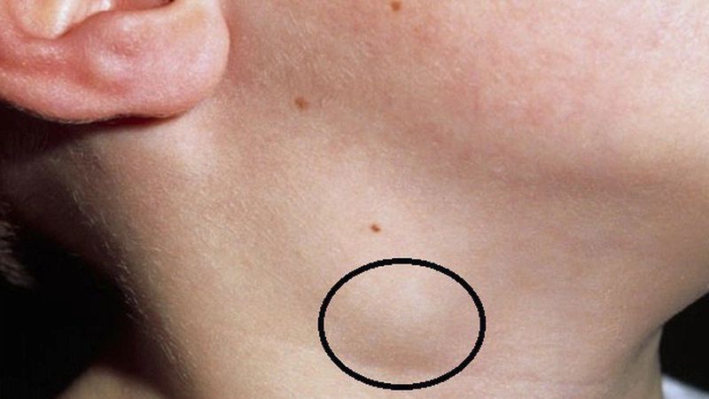 Ung thư phổi có thể di căn tại hạch cổ