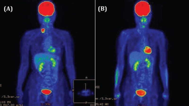Chụp PET/CT là phương pháp có giá trị cao để chẩn đoán ung thư phổi di căn hạch