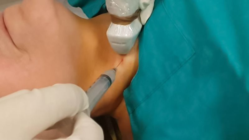 Bác sĩ có thể tiến hành sinh thiết hạch để chẩn đoán ung thư phổi di căn hạch