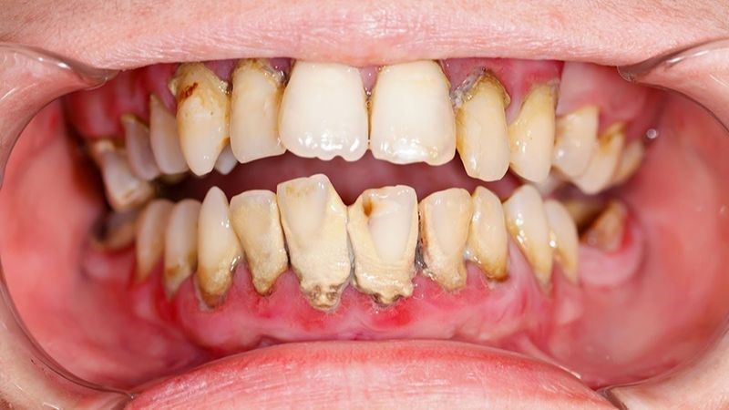 Viêm nha chu có thể là nguyên nhân gây viêm amidan