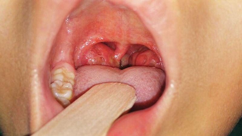 Viêm amidan là tình trạng sưng viêm to vi khuẩn hoặc virus gây nên