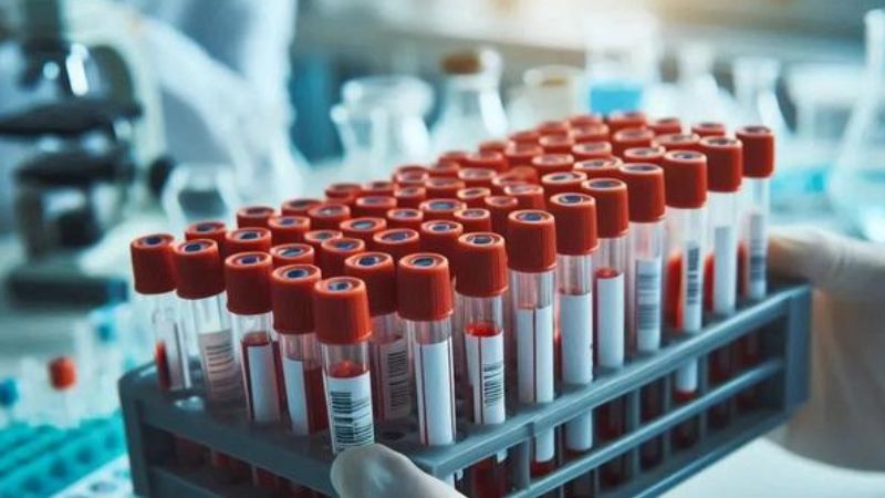 Xét nghiệm máu có thể giúp chẩn đoán viêm gan C Xét nghiệm máu có thể giúp chẩn đoán viêm gan C