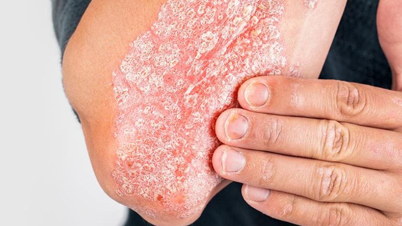 Bệnh vảy nến có thể liên quan đến nguyên nhân gây viêm lưỡi bản đồ Bệnh vảy nến có thể liên quan đến nguyên nhân gây viêm lưỡi bản đồ